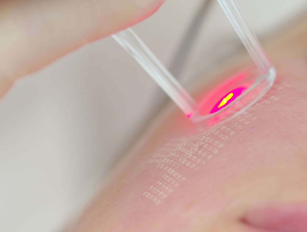 Laser Resurfacing in KL
