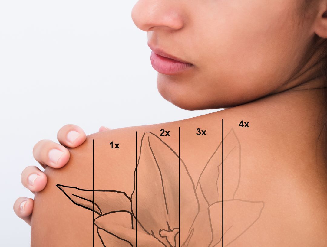 Tattoo Removal in KL by LS Aesthetic