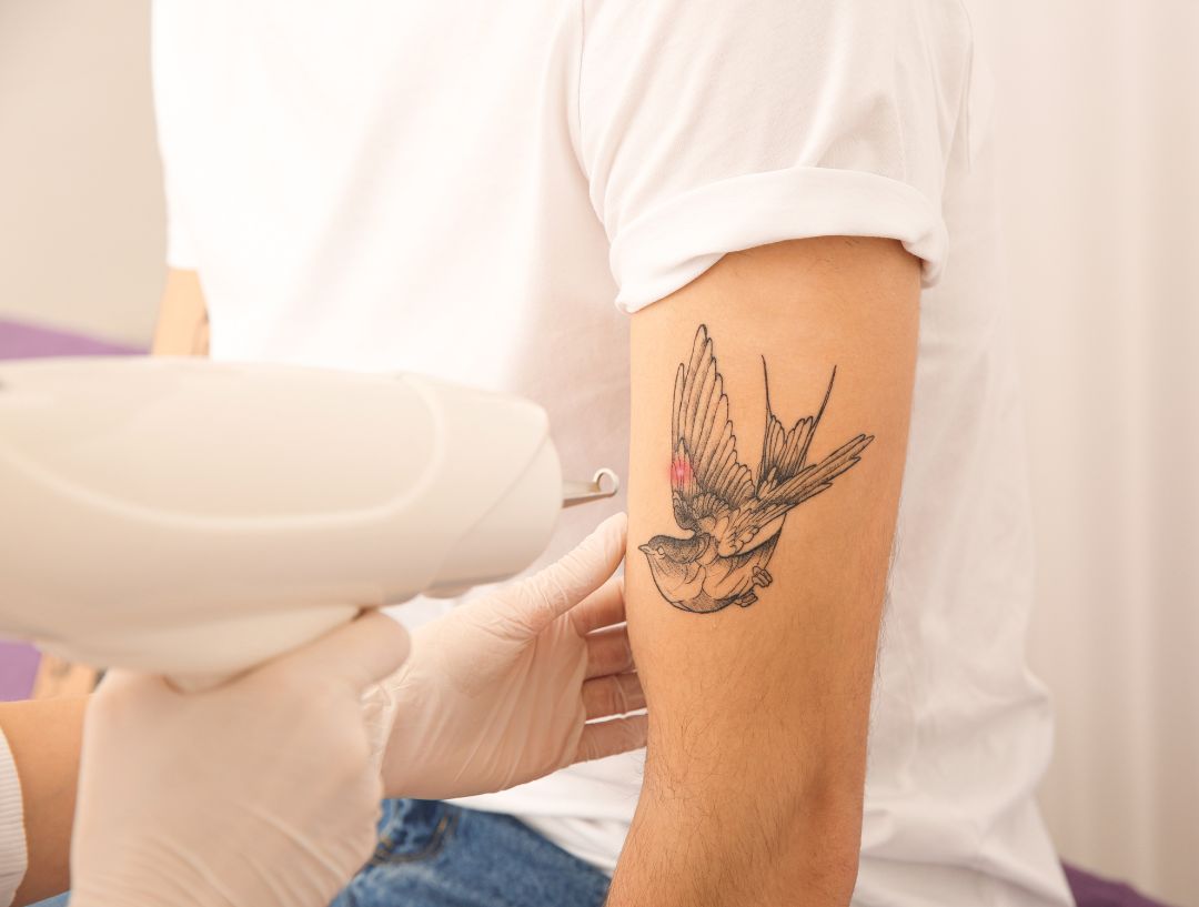 Tattoo Removal by LS Aesthetic